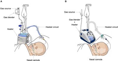 High-Flow Nasal Cannula Oxygen Therapy: Physiological Mechanisms and Clinical Applications in Children